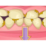 Bad Teeth Makeover
